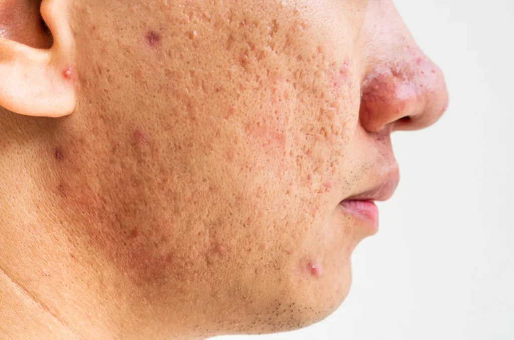 Acne scar Treatment-----11