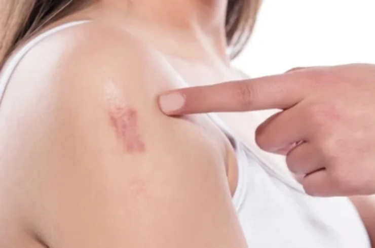 Keloid Management-----0