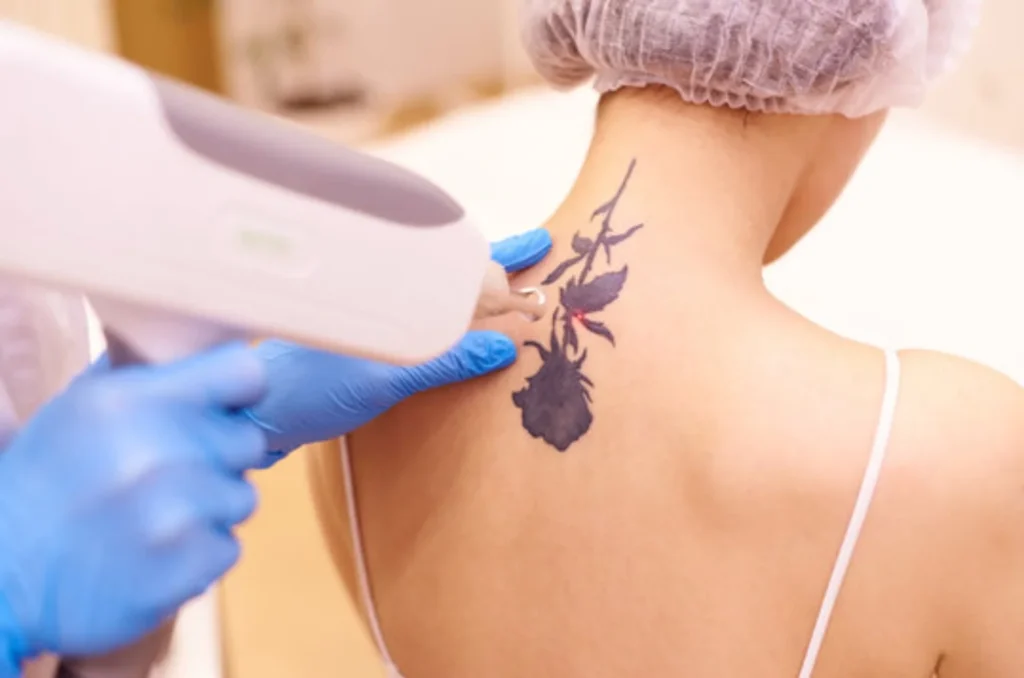 Laser Tattoo Removal------11
