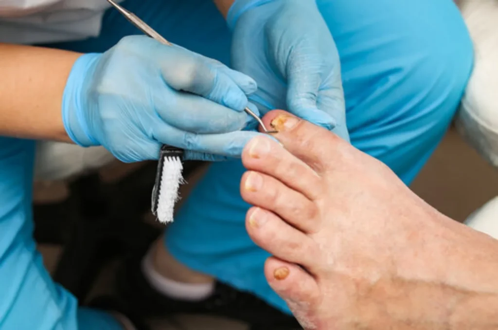 Nail Removal------11