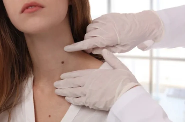 Skin Tag Removal-----0