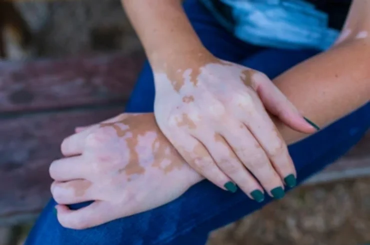 Vitiligo Surgery------0