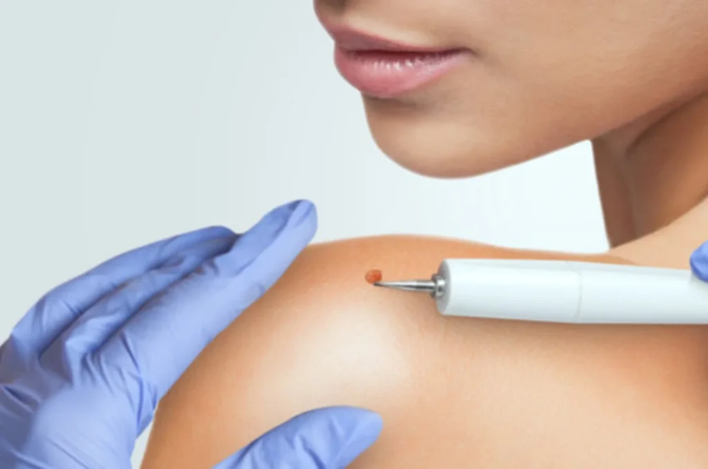 Wart Removal-----11