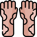 eczema (2)