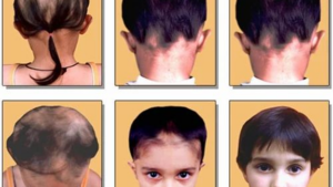 Aira Skin Clinic, Dr. Bhavana Dhana Laxmi