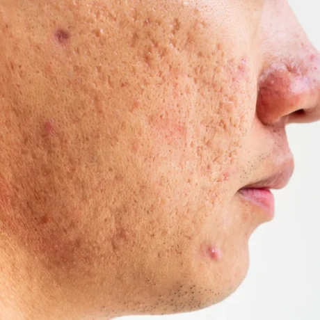 Acne scar Treatment-----11