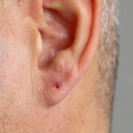 Ear lobe Repair------11