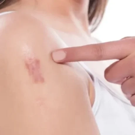 Keloid Management-----0