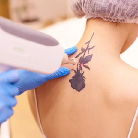 Laser Tattoo Removal------11
