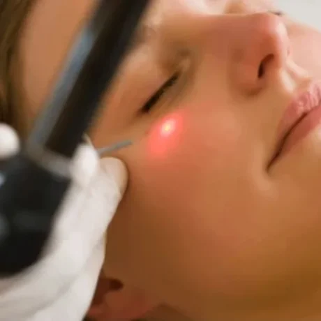 Laser Treatments-----0