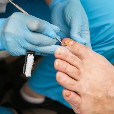 Nail Removal------11