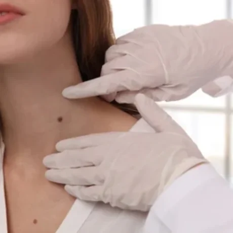Skin Tag Removal-----0
