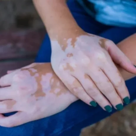 Vitiligo Surgery------0