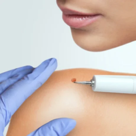 Wart Removal-----11